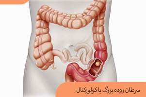 پیشگیری از سرطان روده بزرگ و علائم آن
