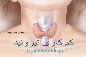 بیماری کم کاری تیروئید و زمان تشخیص و درمان آن