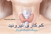 بیماری کم کاری تیروئید و زمان تشخیص و درمان آن